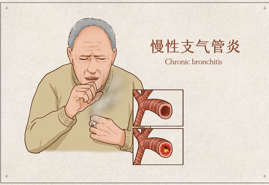 慢性支气管炎的病因和预防措施,你知道哪些?__凤凰网
