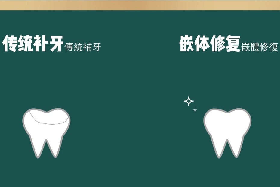 深圳补牙科普补牙材料老掉医生建议做嵌体是真的好吗