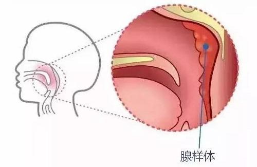 郭明医生:怎么确定孩子是否是腺样体肥大?__凤凰网