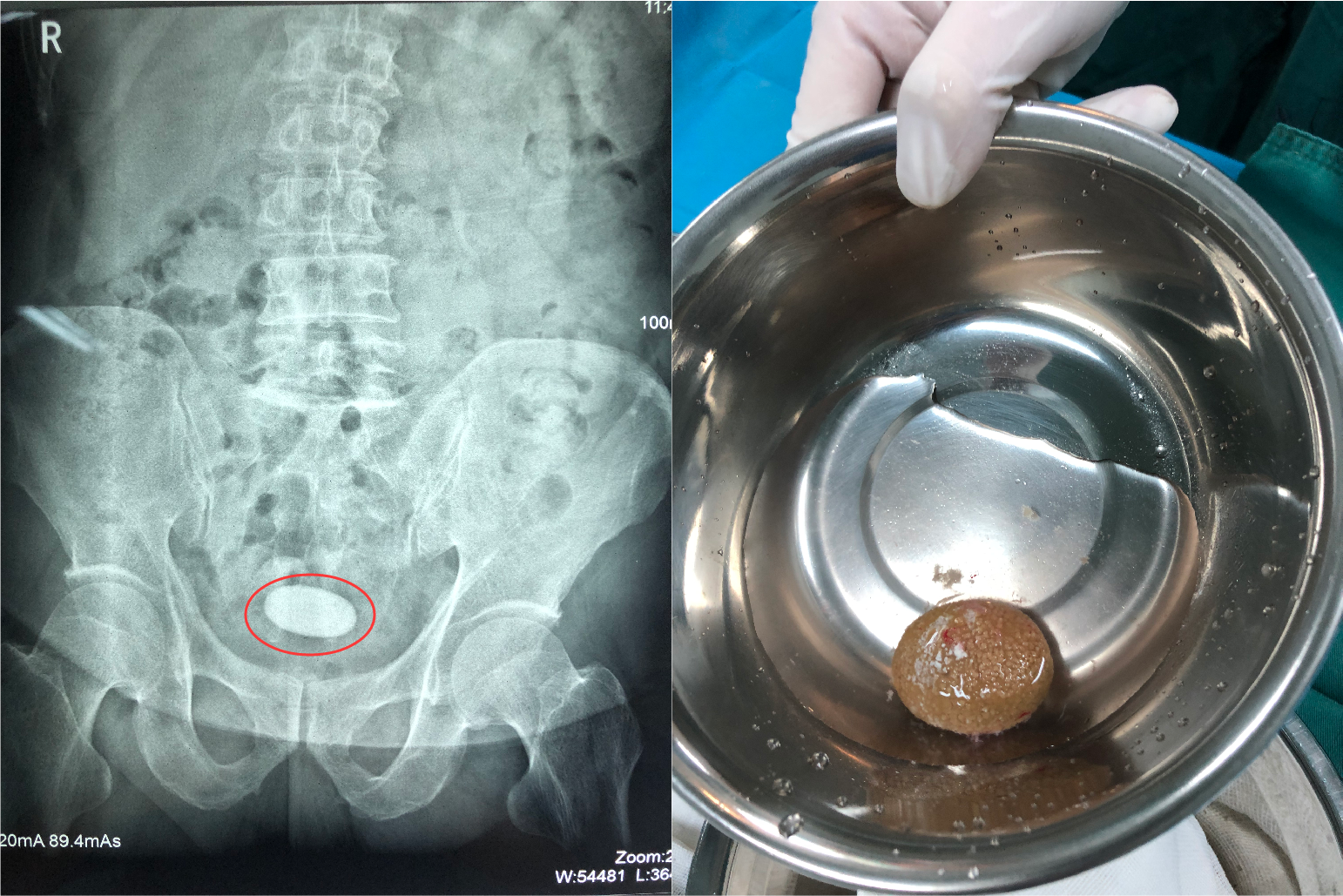 男子尿痛1年多自行吃药,结石长大成"土豆"堵在膀胱里__凤凰网