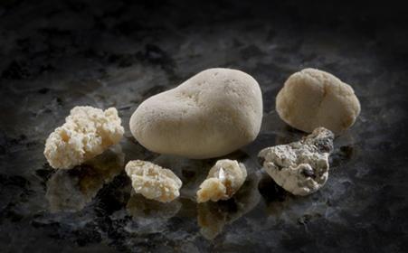 得了肾结石是因为体质太敏感?大部分患肾结石的人都有这个共同点