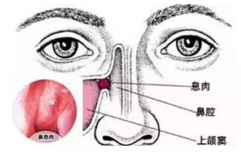 鼻息肉与正常鼻腔图图片