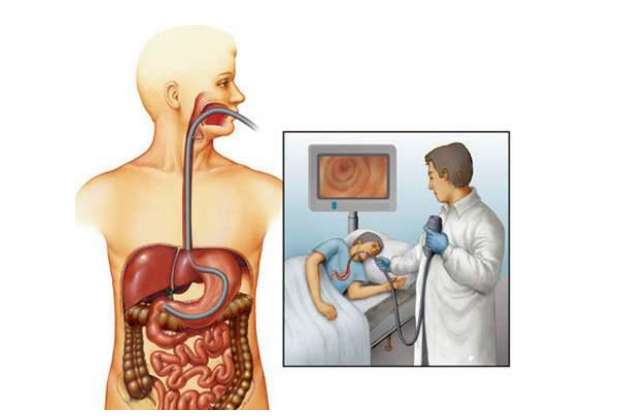 无痛肠镜的过程示意图图片