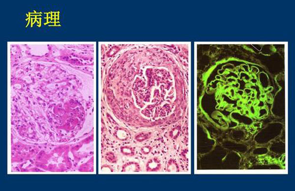 男子iga肾炎肾功能不全西医配合中医临床治愈如何防止恶化