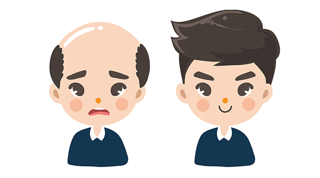 脱发植发,要想形象好,术后要点要记牢