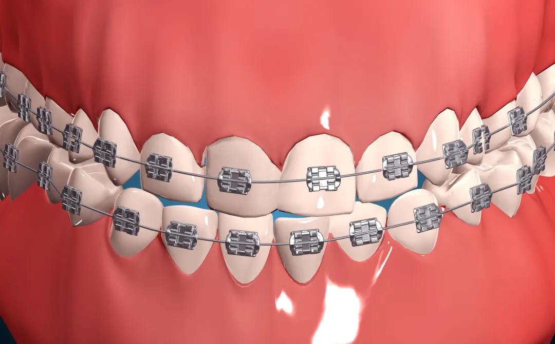 暑期牙齿矫正热孩子几岁做牙齿矫正合适