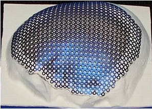 颅骨修补术市面上常见的材料是钛网材料,我们都知道