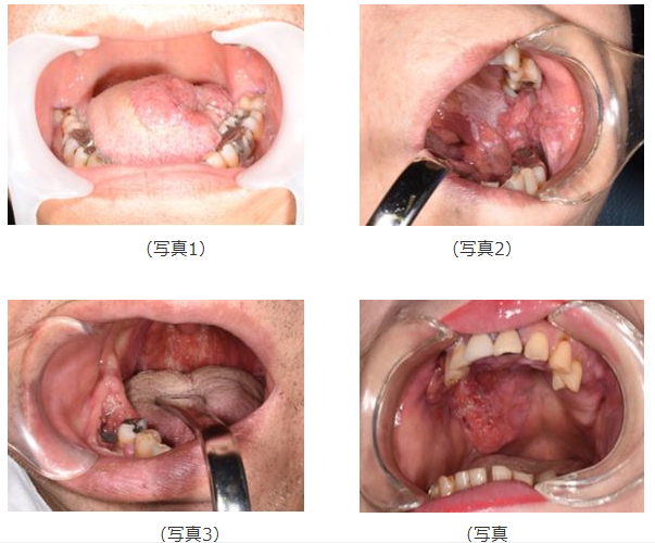 口腔癌早期怎么治疗图片