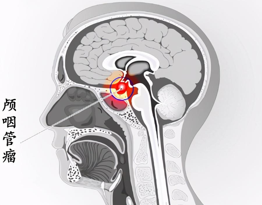 垂体瘤在头部位置图片图片