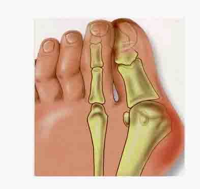 当拇外翻出现后,足底生物力发生变化,慢慢会发现,骨突的位置红肿,磨泡