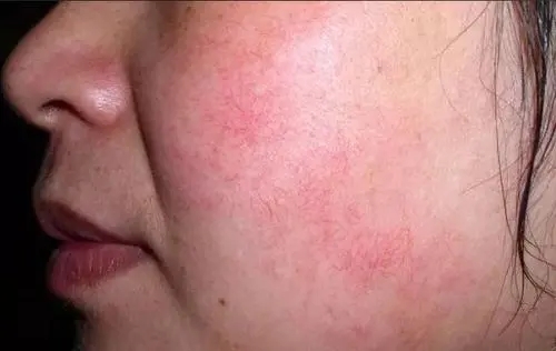 有红血丝的人会形成持续性两颊泛红,还会散发到面部任何部位,看上去比