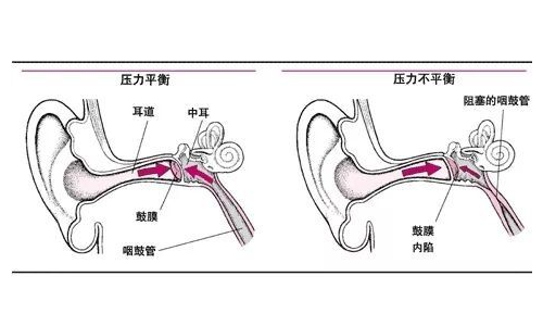 郭明医生:鼓膜内陷是什么原因造成的?