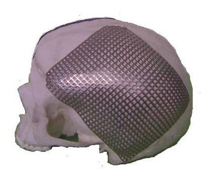 钛网颅骨修复后需要换吗