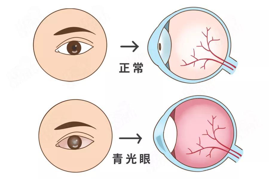 ①先天性青光眼