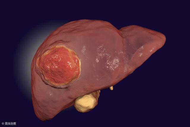 肝癌晚期,腹水难消!靠这一疗法,67岁的他已带瘤生存3年!