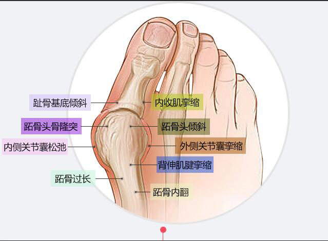 大母脚趾向内歪的原因图片