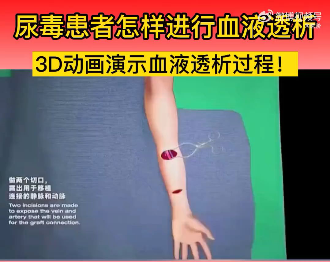 尿毒症患者怎样进行血液透析？3D动画演示血液透析过程