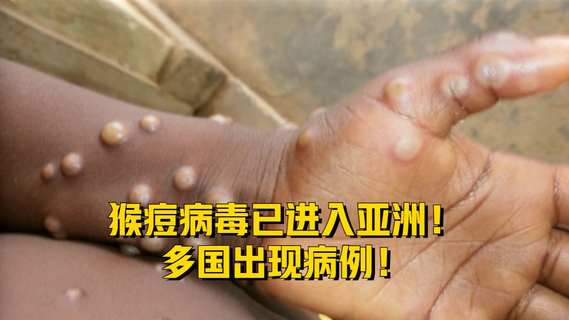 猴痘病毒已进入亚洲!多国出现病例!