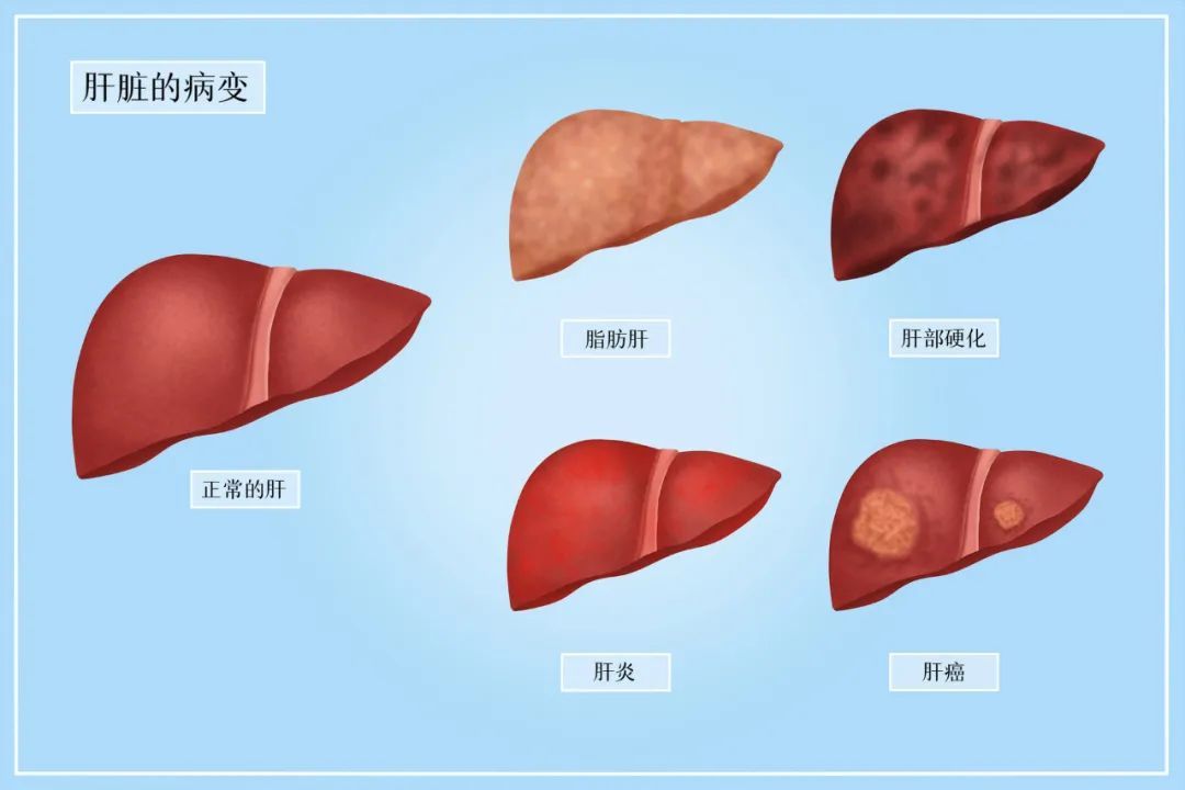 脂肪肝離肝癌僅4步消除脂肪肝做好三件事就夠了