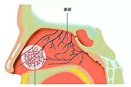 鼻腔黏膜薄图片
