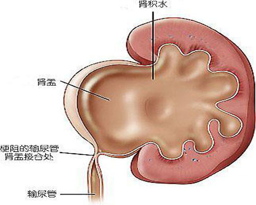 男子肾积水没治疗3年后肾报废,肾积水的危害,中医如何治疗?