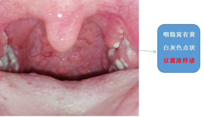 咽部粘膜弥漫性充血,扁桃体及两腭弓明显,腭扁桃体肿大,表面显示黄