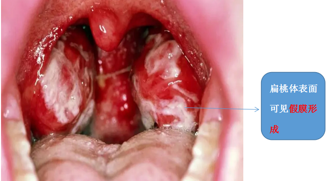 顯示黃白色膿點,咽隱窩有黃白灰色點狀豆腐渣樣滲出,連城一片形式假膜