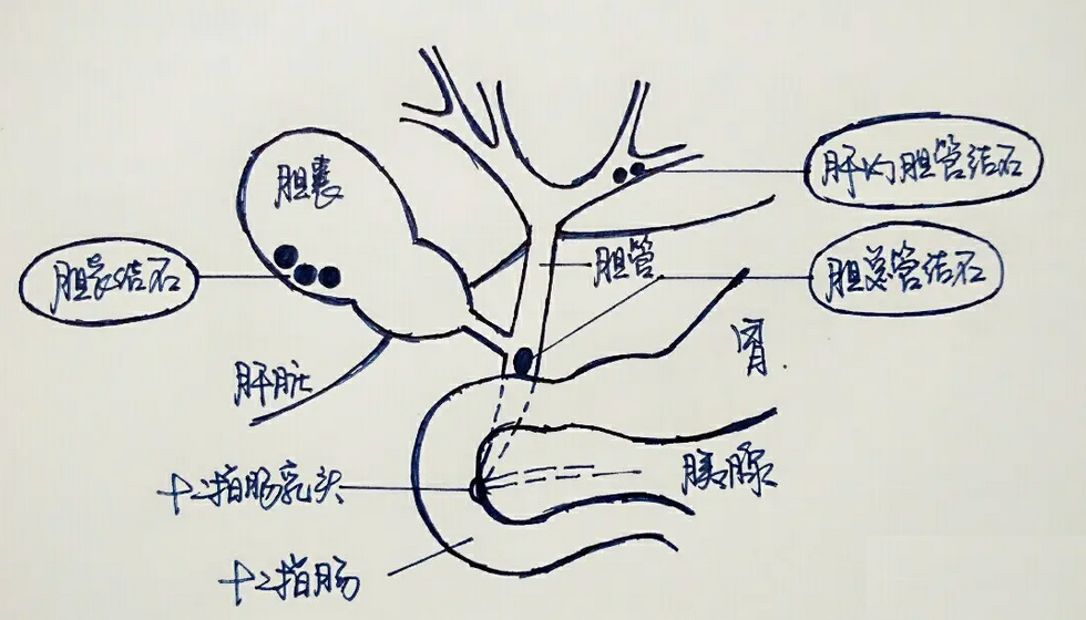 胆囊中一旦长出结石