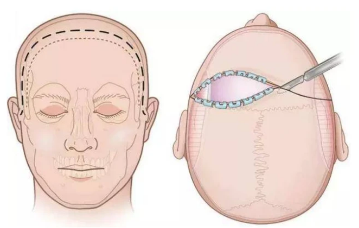 小切口拉皮和冠状切口拉皮哪种好?__凤凰网