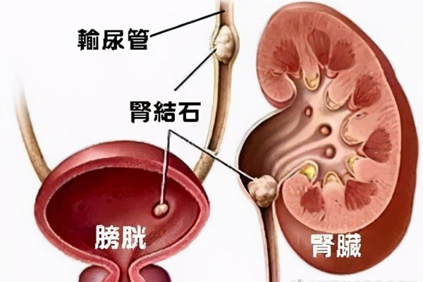 旁腺功能亢进,皮质醇增多症,高血糖,长期卧床,营养缺乏,尿路的梗阻