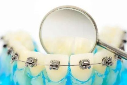 做牙齿矫正<em>一般人</em>需要多长时间？