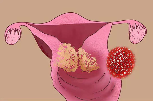 我是如何感染hpv病毒的?有哪些感染途径?如何预防__凤凰网