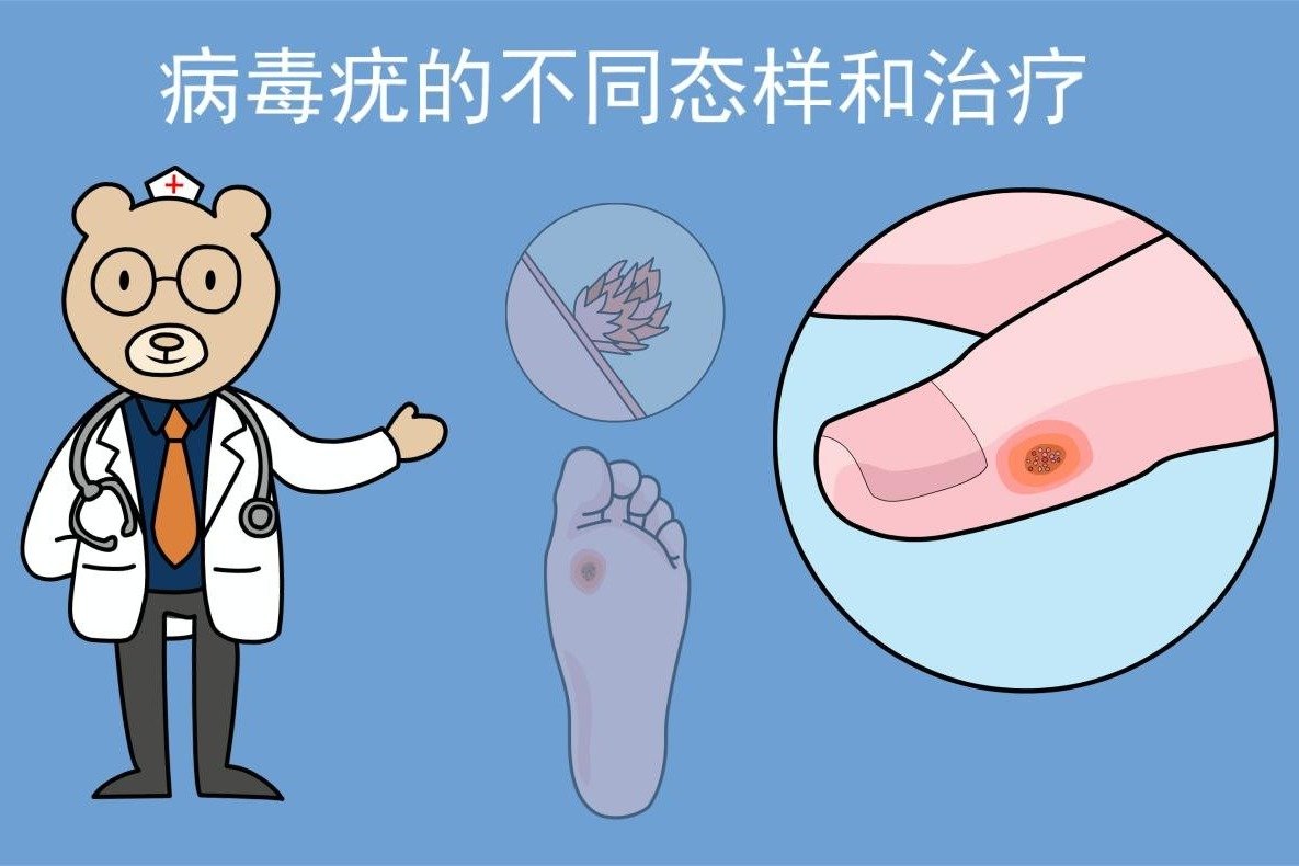 非疙瘩非痣,这些小凸起是病毒感染的疣!_凤凰网